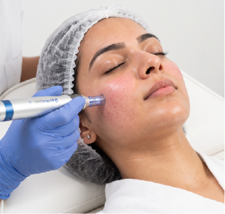 Hillcare Medical Dr Karani Micro Needling Hillcare Medical Dr Karani Micro Needling